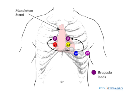 Basics - ECGpedia