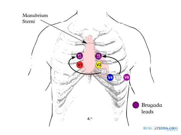 Brugada Syndrome - ECGpedia