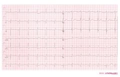 Chamber Hypertrophy and Enlargment - ECGpedia