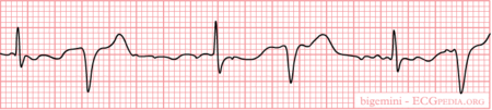 Ventricular Premature Beats - ECGpedia