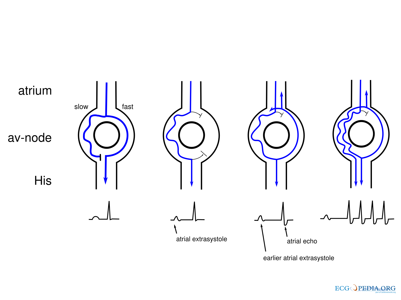 bestand-re-entry-svg-ecgpedia