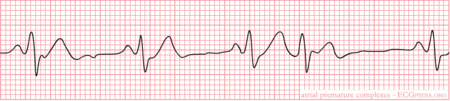 Ectopic Complexes - ECGpedia