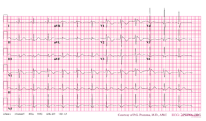 Brugada syndrome type1 example4.png