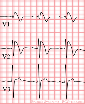 Type 2 ECG with saddle-back type ST-segment elevation in V 2 