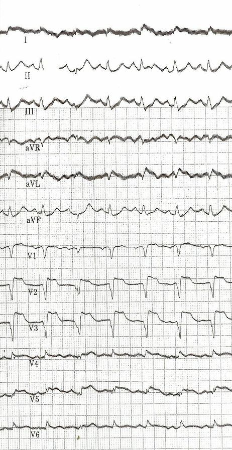 File:Casus1 1.jpg - ECGpedia