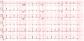 The 12 lead ECG of this patient shows PTa depression, but no ST elevation