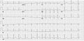 Atrial fibrillation with reasonable rate control