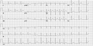 File:Afib ecg.jpg - ECGpedia