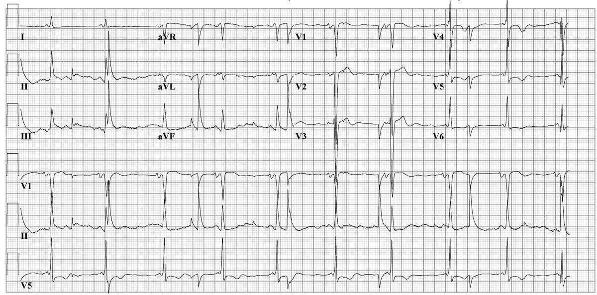 File:Electric noise ecg2.jpg - ECGpedia