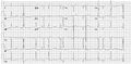 Another example of an artifact caused by an electrical appliance. The patients rhythm is regular. This strip shows 10 QRS complexes.