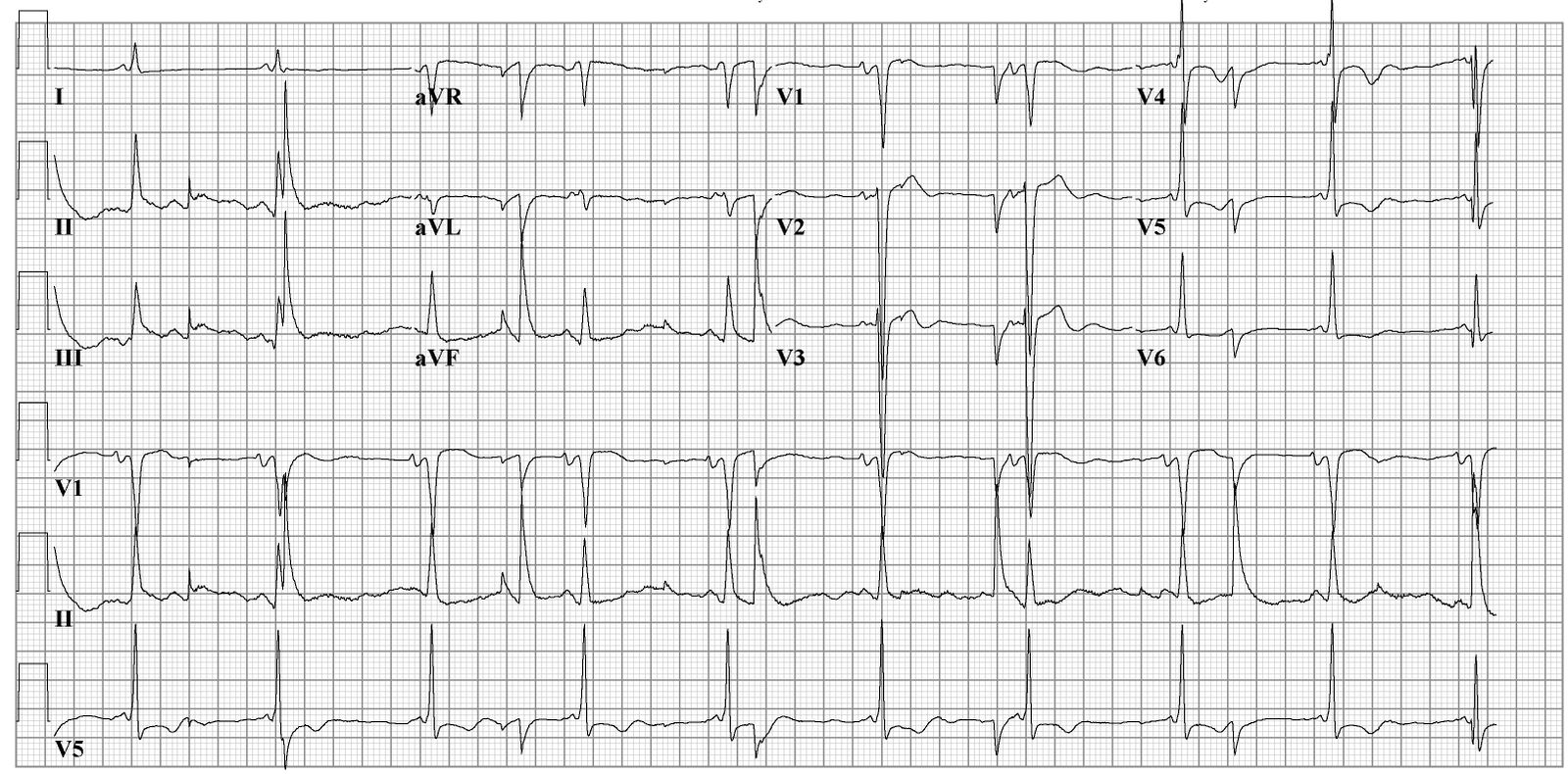 File:Electric noise ecg2.jpg - ECGpedia