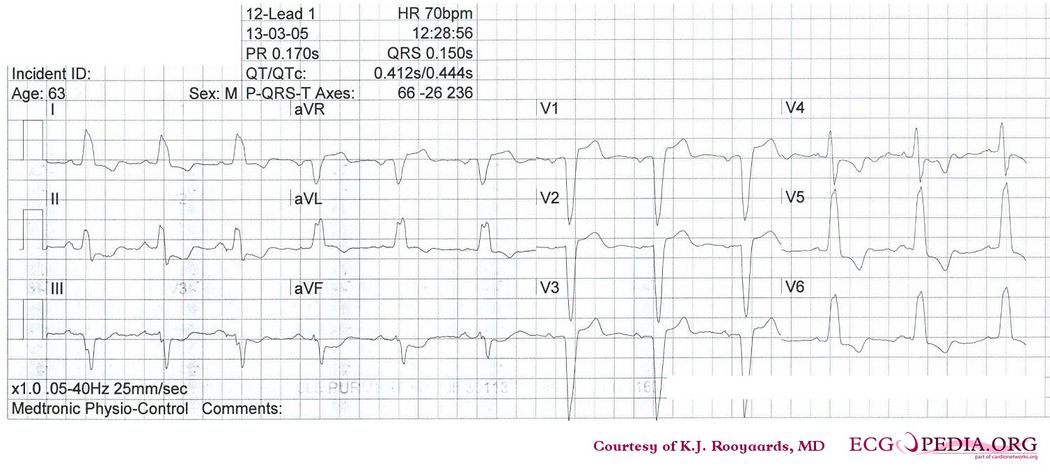 Answer Case 3 Ecgpedia