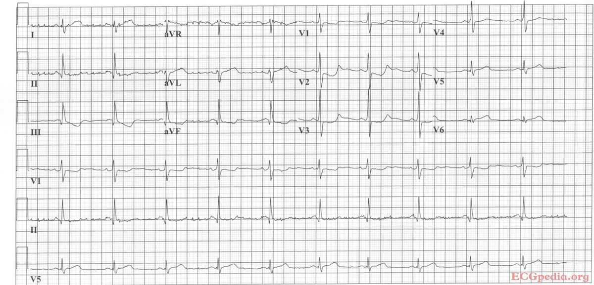 Antwoord Oefeninfarct 5 Ecgpedia