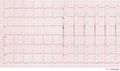 Ecg met extreme LVH. Deze patiënt had ook een stijging van de hartenzymen als gevolg van subendocardiale ischemie bij de hypertrofie.