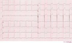 Chamber Hypertrophy and Enlargment - ECGpedia