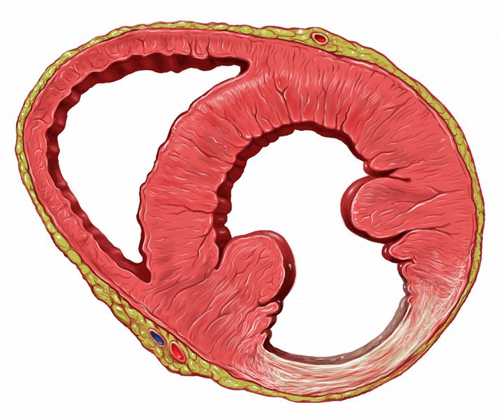 Bestand:Heart inferior wall scar.jpg