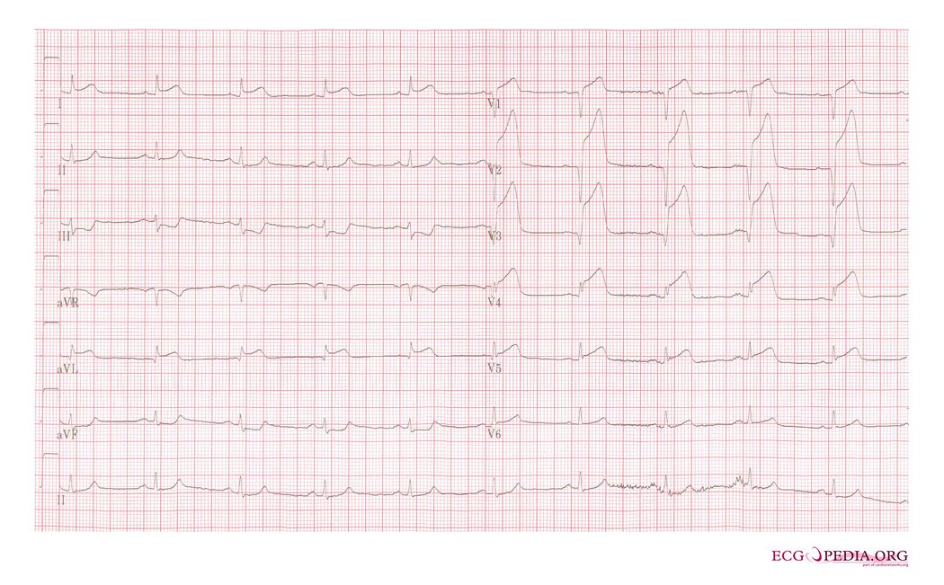 MI 15 - ECGpedia