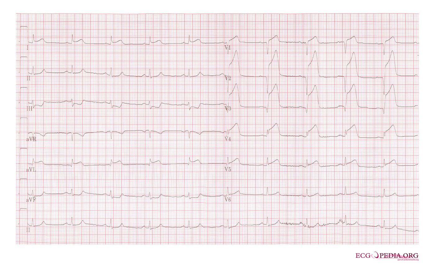 Mi 15 Ecgpedia