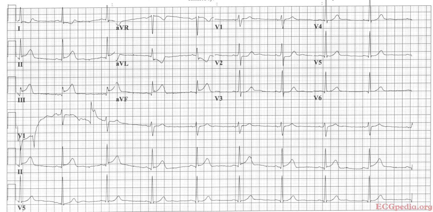 mi-4-ecgpedia