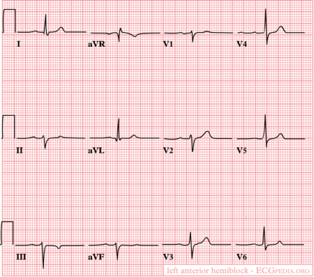 Intraventricular Conduction - ECGpedia