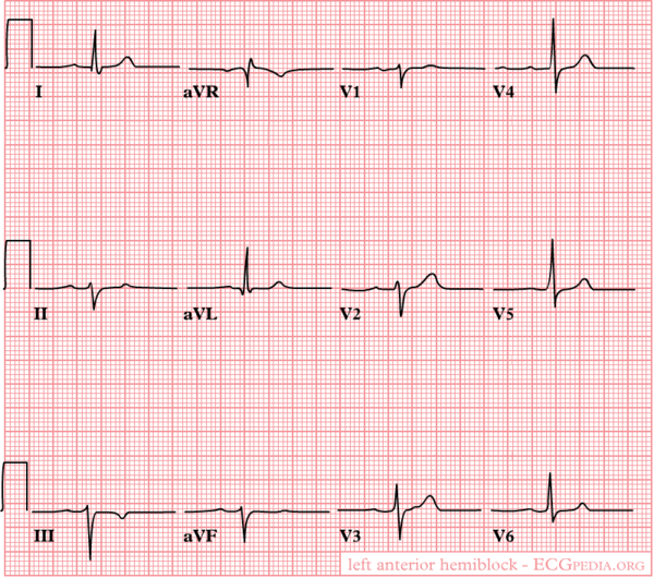 Intraventricular Conduction | Hippocrates Guild