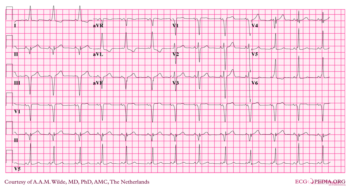 Bestand:AW00002.png - ECGpedia