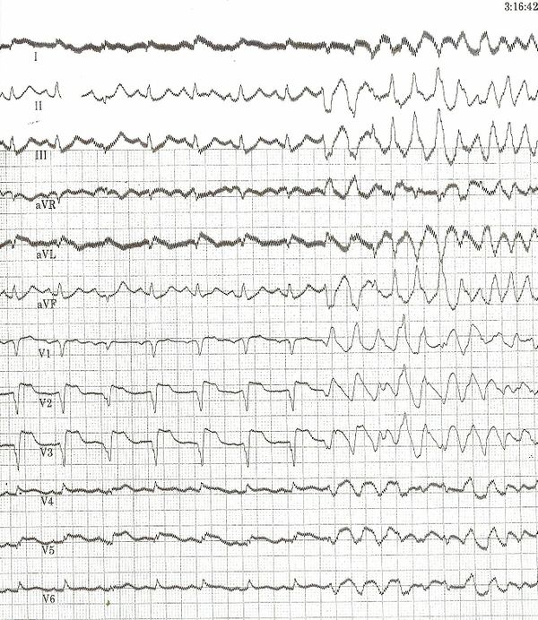 Answer example 1 question 2 - ECGpedia