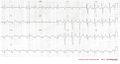 Consecutive ECGs of a patient with hyperkalemia. After correction of potassium levels. ECG3