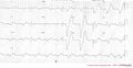 Consecutive ECGs of a patient with hyperkalemia. ECG1