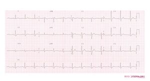 Brugada syndrome type2 example2.jpg
