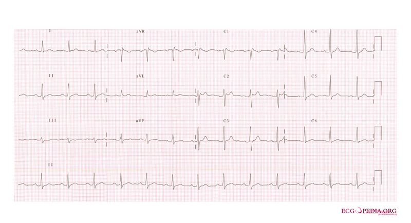 Bestand:Brugada syndrome type2 example2.jpg