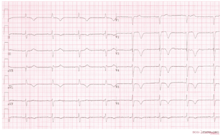 Myocardial Infarction - ECGpedia