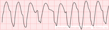 Ventricular Tachycardia - ECGpedia