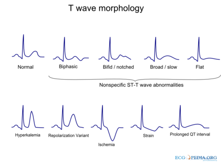 ST Morphology - ECGpedia