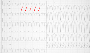 Wide qrs tachy AAM3.png
