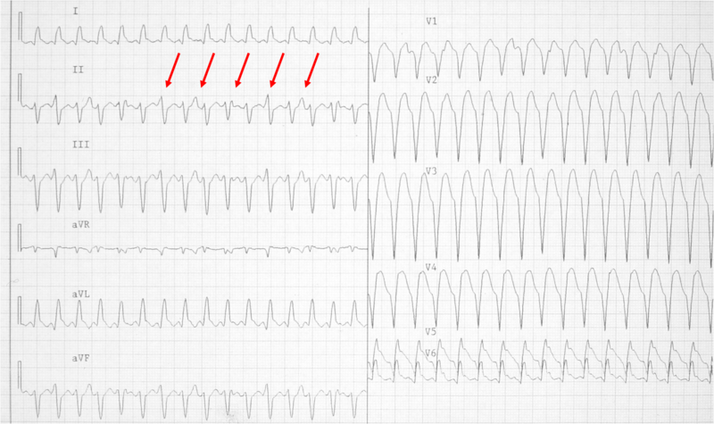 Bestand:Wide qrs tachy AAM3.png