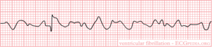 Rhythm ventricular fibrillation.png