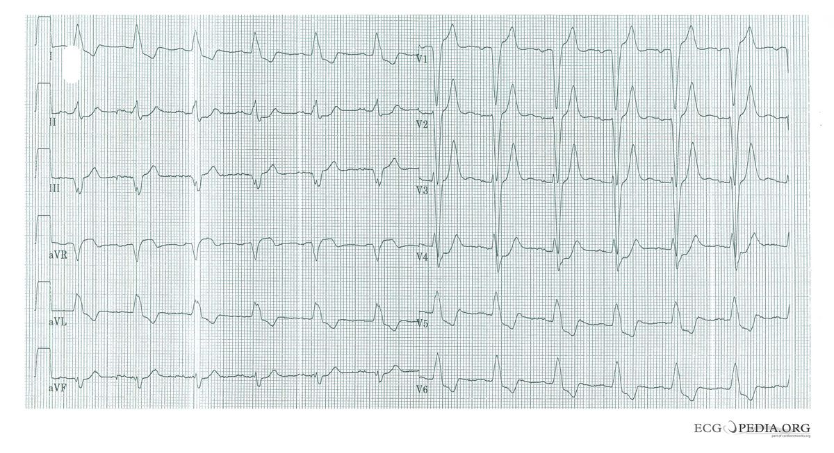 File:LBBB with AMI.jpg - ECGpedia