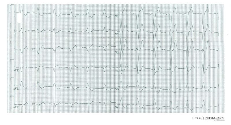 Bestand:LBBB with AMI.jpg