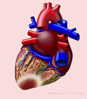 Heart with P infarct.png