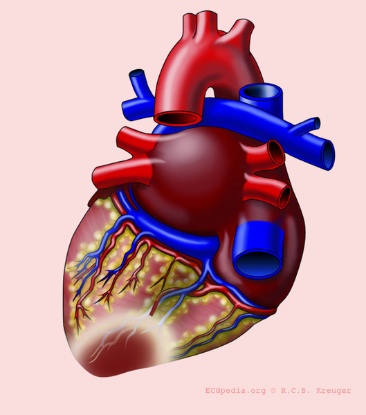 Bestand:Heart with P infarct.png
