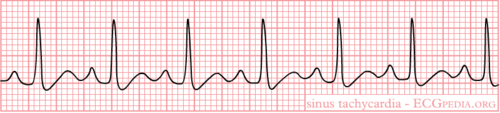 Sinustachycardie - ECGpedia