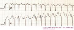 Atrial Fibrillation - ECGpedia