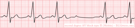 AV Conduction - ECGpedia