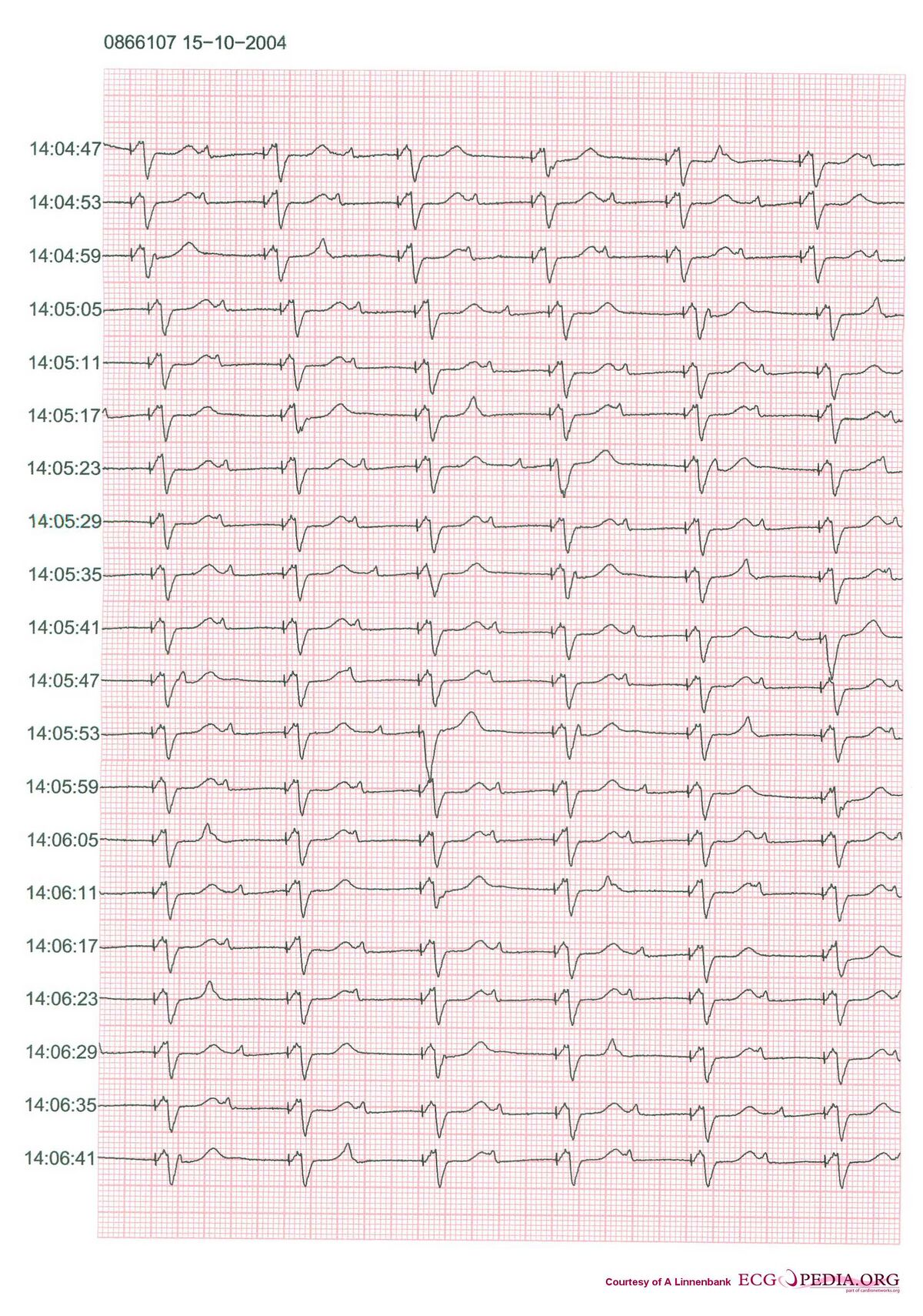 File:Pacemaker retrograde wenkebach.jpg - ECGpedia