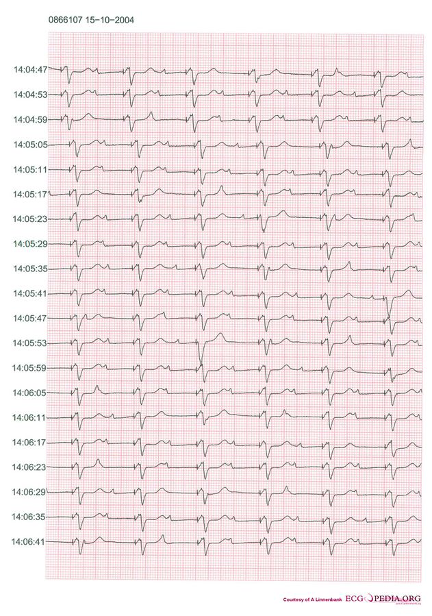 File:Pacemaker retrograde wenkebach.jpg - ECGpedia