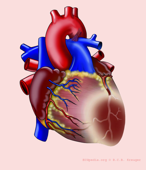 Bestand:Heart with AL infarct.png