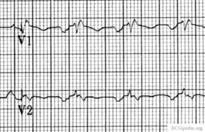 ECG LAtrD v1.jpg