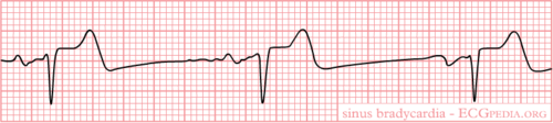 Sinus Bradycardia - ECGpedia