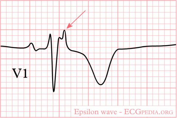 Arrhythmogenic Right Ventricular Cardiomyopathy - ECGpedia